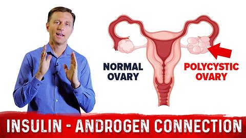 Why Does Insulin Cause PCOS (Polycystic Ovary Syndrome)? – Dr.Berg