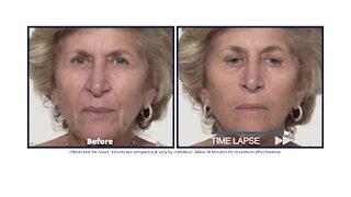 10-minutes can help you look younger with Plexaderm