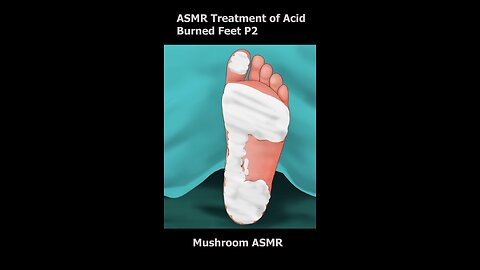 ASMR video of treatment of acid burned feet so satisfying...