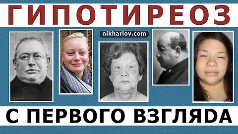 Как выглядит пациент с ГипоТиреозом: отёки, полулунное лицо, выпадение бровей, облысение, микседема