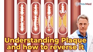 Understanding Plaque and how to reverse it