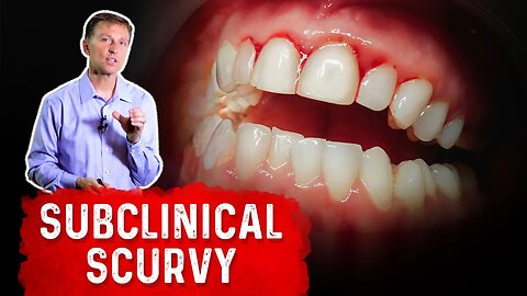 Vitamin C Deficiency (Subclinical Scurvy) – Causes, Symptoms, and Remedies – Dr. Berg