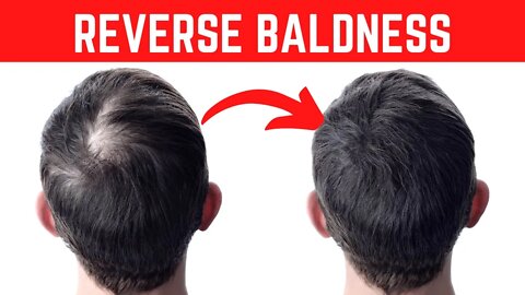 Science Proves It! This Oil May Reverse Baldness And Hair Loss