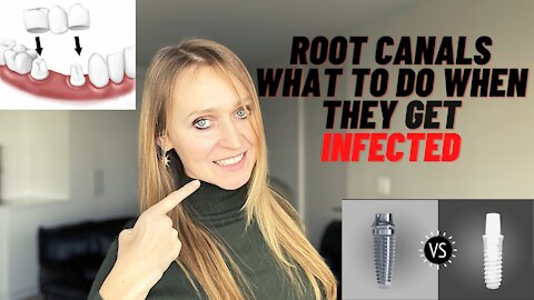 Are Root Canals Good for You?| Should You Remove Root Canals| What are the Alternatives ?