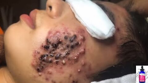 Blackheads Removal & Pimple Popping Videos