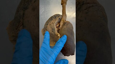 Abnormal Human Lung!