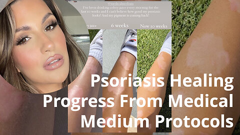 Psoriasis Healing Progress From Medical Medium Protocols - Repost from @nicoletanneberg