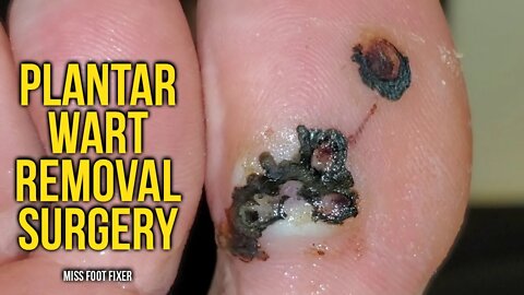 WOW! HUGE FOOT WART EVER??? ***PLANTAR WART REMOVAL SURGERY***