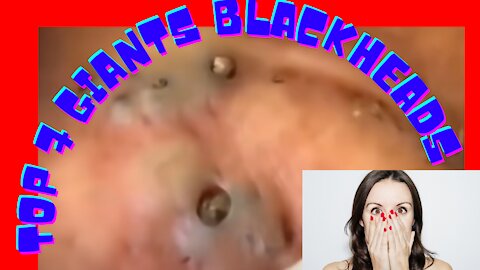 BLACKHEADS AND WHITEHEADS - TOP 7 BEST GIANTS BLACKHEADS REMOVALS