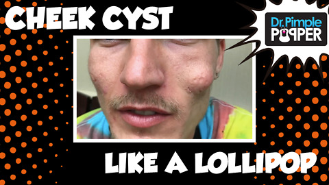 Cheek Cyst Like a Lollipop!