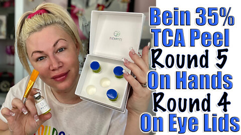 Bein 35% TCA Peel Round 5 on Hands, Round 4 on Eye Lids Acecosm.com | Code Jessica10 saves you $$$