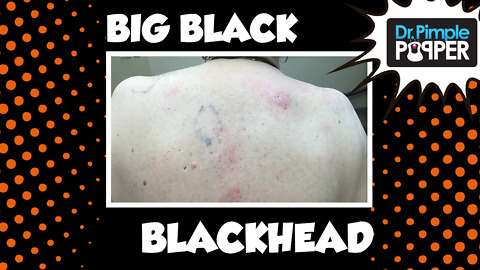 Return of the BIG, BACK Blackheads