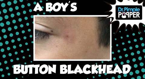 A Boy's Button Blackhead