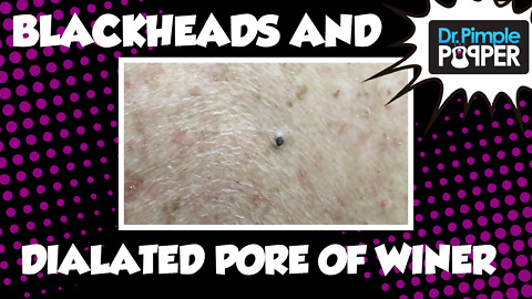 Blackheads & a Dilated Pore of Winer, courtesy of Dr Pimple Popper