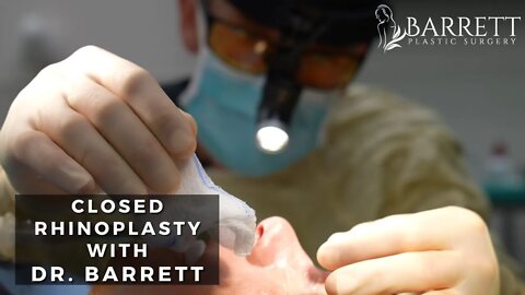 Closed Rhinoplasty! | Barrett Plastic Surgery