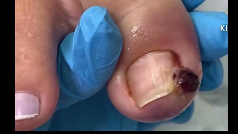 Unha encravada, granuloma gigante | Ingrown toenail, giant granuloma! #nails #podologia #dor
