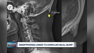 Tech disorder? Smartphones linked to bizarre horn-like skull bumps