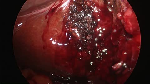 Sithsurgeon - Laparoscopic Cholecystectomy with Intraoperative Cholangiogram