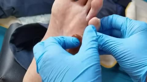 Treatment for heel warts in a pedicure tutorial. Plantar wart excision. The foot has two warts.