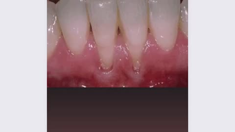 How to stop receding gums| tissue grafting #periodontics#dentalcare