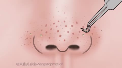 Satisfying Full Blackhead Treatment At Home! ASMR skincare animation丨Meng's Stop Motion