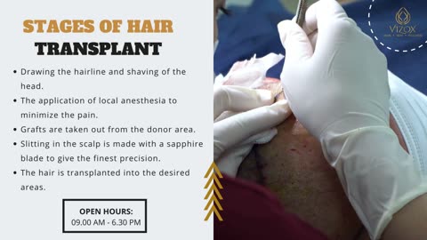 Best Hair Transplant Clinic in Chandigarh - Vizox Clinique