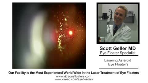 Eye Floater Treatment training video for Ophthalmologists