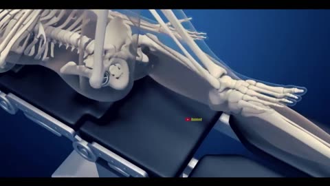 The Art of Joint Restoration: Understanding Hip Replacement Surgery (3d animation)