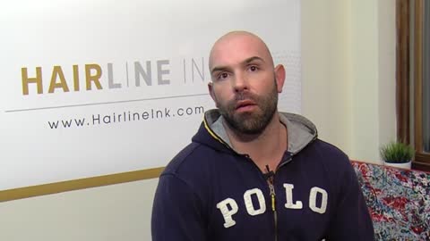 scalp micropigmentation for balding