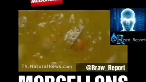 McDonalds food and Morgellons disease