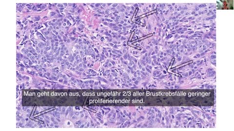 Dr. Ute Krüger, Pathologin in Schweden, Auffälligkeiten bei Brustkrebs nach Covid-Impfungen