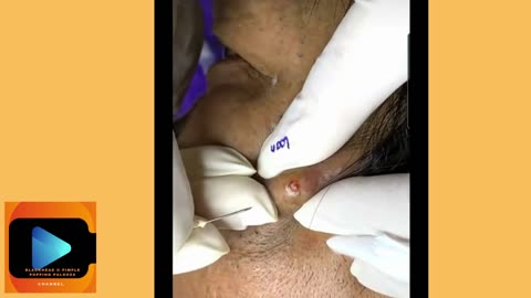 Satisfying Pimple Popping