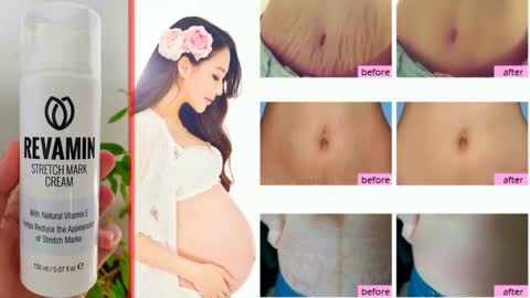 Revamin Stretch Mark Review Say goodbye to strech marks,Order now a limited quantity