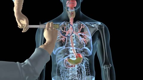 How to insert a nasogastric tube for NG intubation - 3d animation