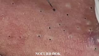 Ultimate Blackhead Extractions: A Popping Compilation