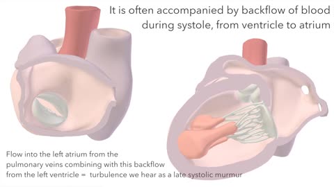 Mitral valve prolapse animation