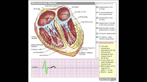 Dr Stanley's ECGcourse.com | Idioventricular Tachycardia Tutorial