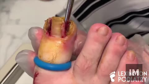 Ingrown toenail medical procedure