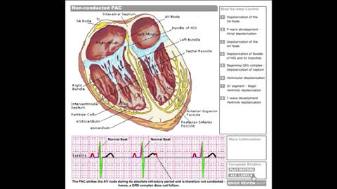 Dr Stanley's ECGcourse.com | Non-conducted PAC Tutorial