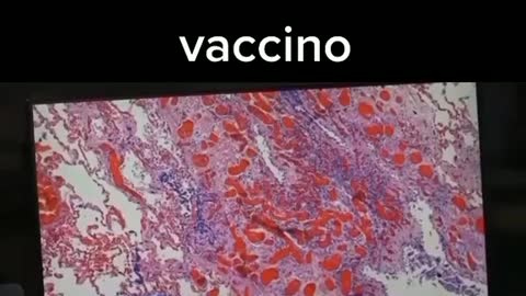 Servizio TC News “Autopsie, danni da vaccino” - Nov. 2021