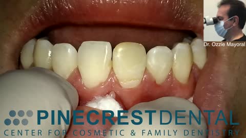 Cosmetic Dentistry Bonding Single Front Teeth Pinecrest Dental Dr. Ozzie Mayoral 2020