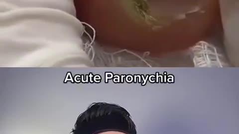 Acute paronychia