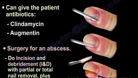 Paronychia - Everything You Need To Know - Dr. Nabil Ebraheim