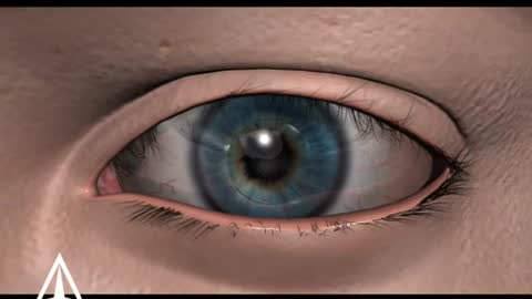 LASIK Surgery - 3D Medical Animation