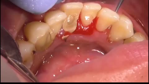 Removing Plaque From Teeth