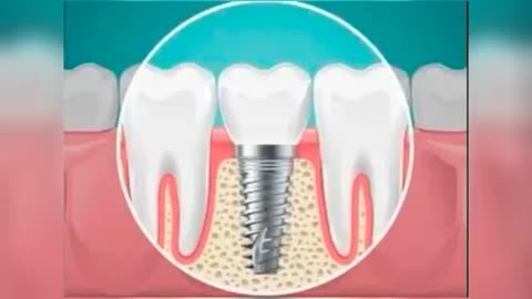 The Smile Institute - Dental Implants in San Antonio TX