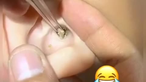 acne insect
