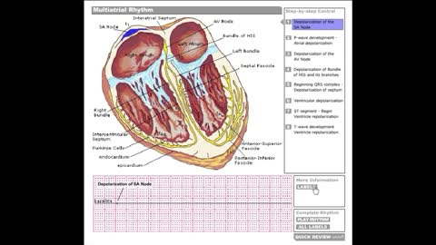 Dr Stanley's ECGcourse.com | Multiatrial Rhythm Tutorial