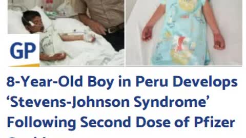 8-Year-Old in Peru Gets ‘Stevens-Johnson Syndrome’ Following Second Dose of Pfizer Covid-19