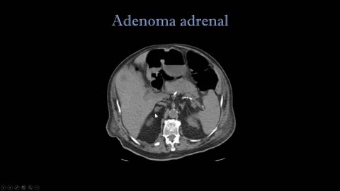 Adenoma adrenal